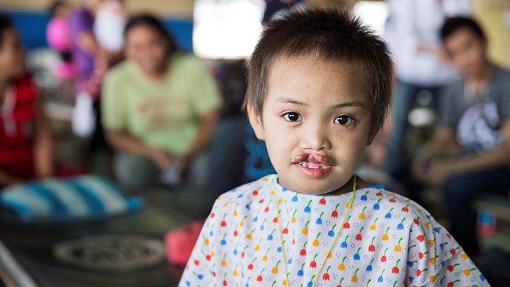 En filippinsk pige med læbespalte før operation