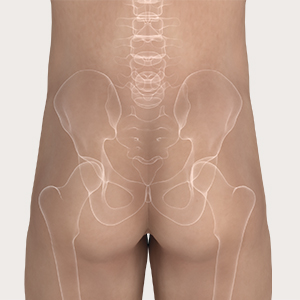 Trin 1 i appliceringen af Mepilex Border Sacrum
